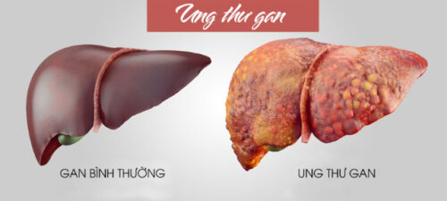 Bệnh ung thư gan hiện nay