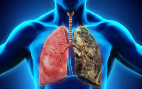 Dấu hiệu của bệnh ung thư phổi